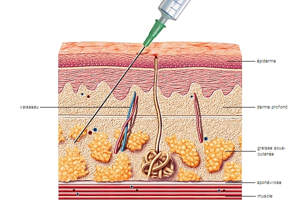 injection sous cutanée ou injection hypodermique LAROUSSE