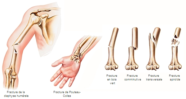 Types de fractures