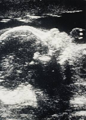 Échographie d'un fœtus de huit mois