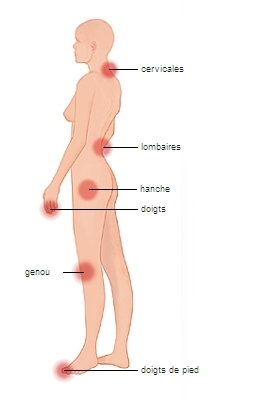 Arthrose de la hanche - Symptômes et traitement de l'arthrose