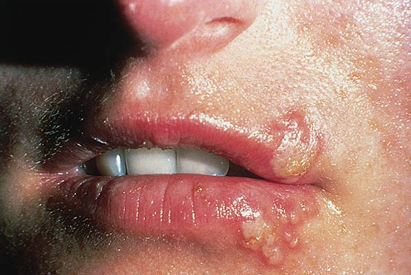 Herpès buccal Herpès buccal
