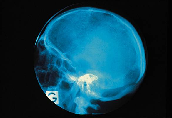 Radiographie du crâne