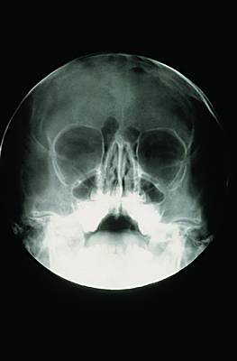 Radiographie des sinus de la face