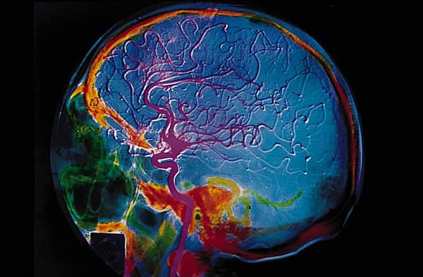 Artériographie cérébrale